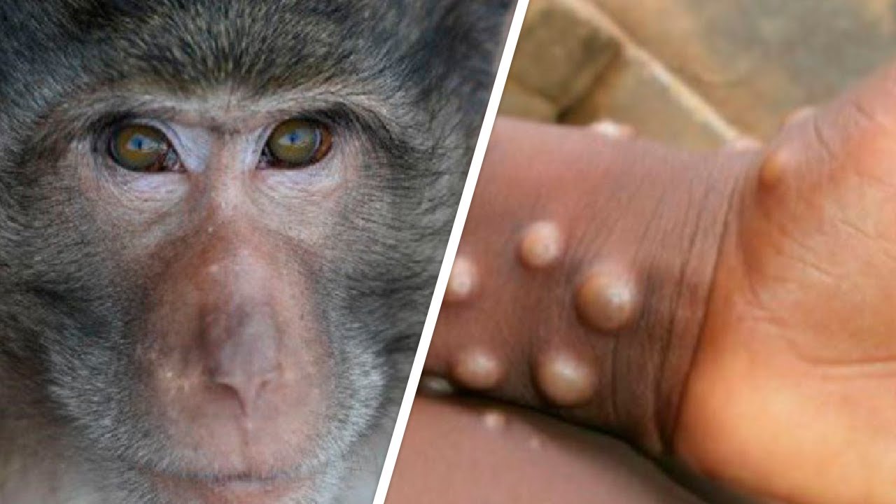 ВОЗ объявила вспышку оспы обезьян пандемией - фото 1