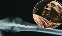  В древней мумии нашли современный ортопедический штифт   - фото 1