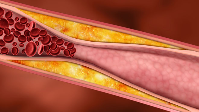 Высокое содержание холестерина в крови провоцирует распространение раковых клеток по всему организму - фото 1